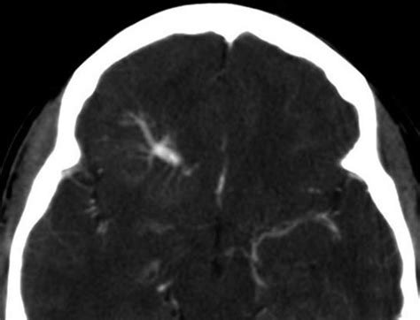 14 Developmental Venous Anomaly | Radiology Key