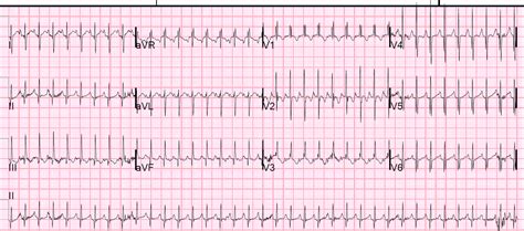 Dr. Smith's ECG Blog: A very fast narrow complex tachycardia in an Infant