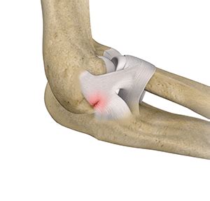 Lateral Ulnar Collateral Ligament Injuries Orlando, FL | Ligament ...