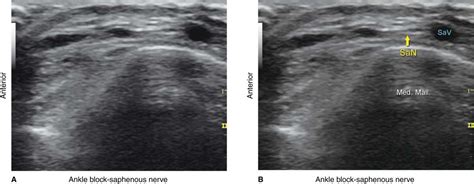 Ultrasound-Guided Ankle Block | Anesthesia Key