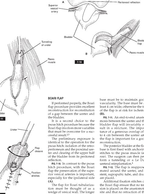 Figure 7-1 from PSOAS HITCH , BOARI FLAP , AND COMBINATION OF PSOAS HITCH AND BOARI FLAP 7 ...