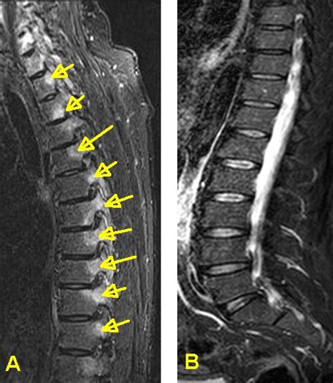 Spinal Inflammation in AS