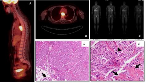 Representative imaging and histology from case two with mediastinal... | Download Scientific Diagram