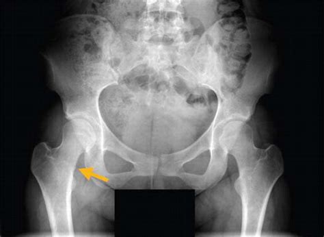 Femoral Neck Stress Fracture | Journal of Orthopaedic & Sports Physical ...