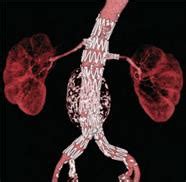 Endovascular Abdominal Aortic Aneurysm Repair (EVAR): Vascular Institute - Navicent Health