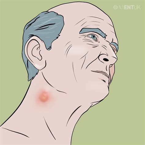 Lump On Neck Behind Ear