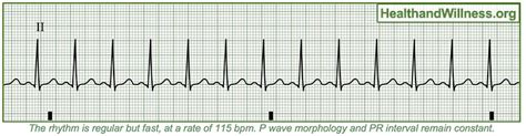 How to Read an EKG Rhythm Strip | Health And Willness