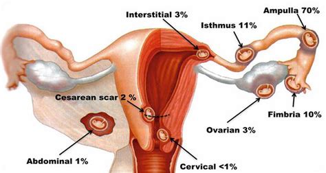 Interstitial pregnancy definition, causes, symptoms, diagnosis & treatment