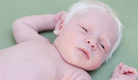 Upbeat News - This Baby Was Born With White Hair And Doctors Had No ...