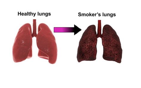 Why does smoking make your lungs go black? | Culture Online - UCL ...