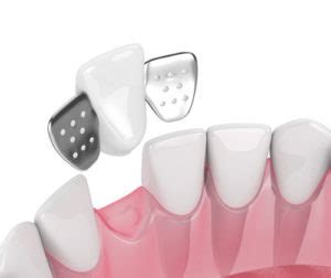 Single Tooth Replacement | Panorama Dental