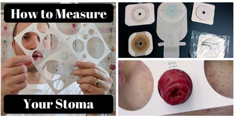 Ileostomy Vs Colostomy Colostomy Ileostomy Ostomy