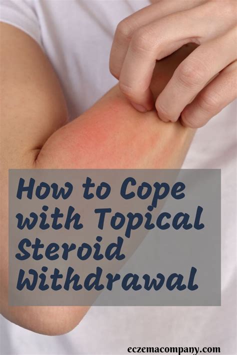 How to Cope with Topical Steroid Withdrawal in 2021 | Topical steroid withdrawal, Steroids, Topical