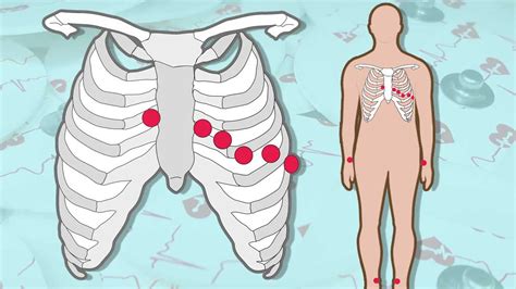 Ekg Lead Placement Guide