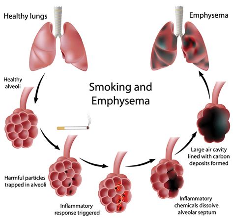 Emphysema - Causes, Signs, Symptoms, Stages, Expectancy & Treatment