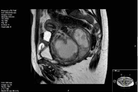 MRI -scan: A sagittal T2-weighted view showing a pedunculated mass... | Download Scientific Diagram