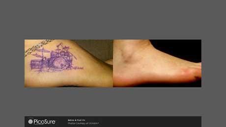 Picosure Tattoo Removal Before and After - Lihue, HI: Eye Care Center of Kauai