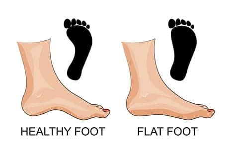 Flatfoot Reconstruction Can Be Effective Even for Older Patients, Per HSS Study - Rehab Management