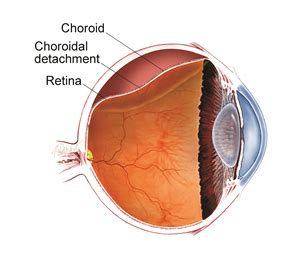 Choroidal Detachment - Patients - The American Society of Retina Specialists