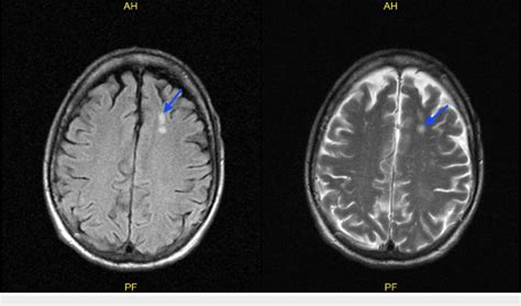 Brain Lesions Mri