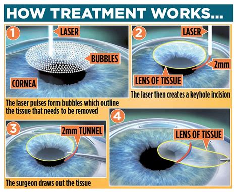 Anyone underwent femto-LASIK (laser eye surgery)? - Off Topic ...