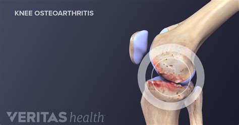 How common is knee arthritis – Health