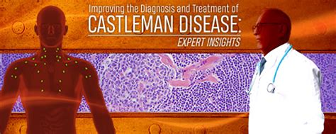 Updates in the Diagnosis and Treatment of Castleman Disease: Expert Perspectives - CDCN