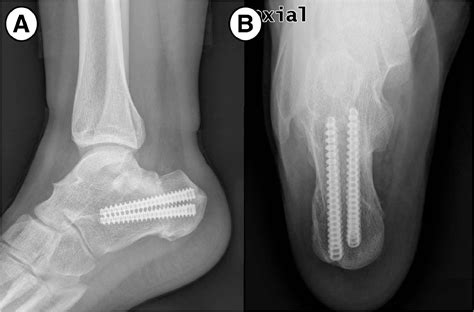 Realignment Calcaneal Osteotomy for Bilateral Complete Talocalcaneal Synostosis: A Case Report ...