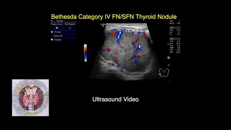 Bethesda Category IV FN/SFN Thyroid Nodule Video - Thyroid Ultrasound Video Atlas - YouTube