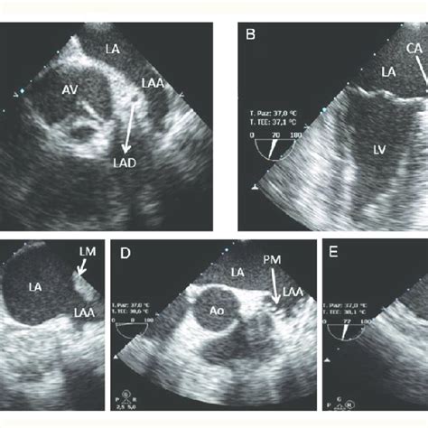 Devices for surgical left atrial appendage closure. (A) AtriClip system... | Download Scientific ...