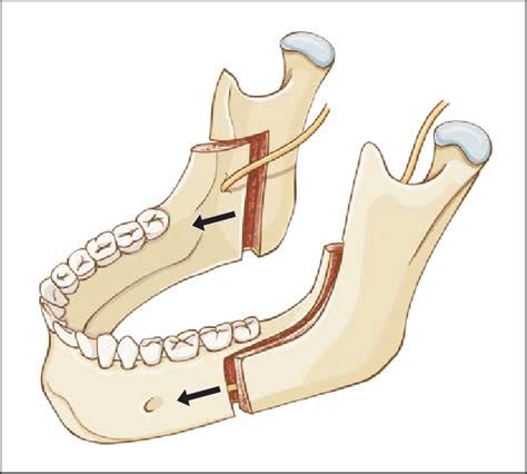 Mandibular sagittal split osteotomy Treatment for International Patient