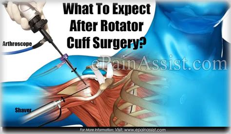 What To Expect After Rotator Cuff Surgery? (Recovery Period) | Rotator cuff surgery, Rotator ...