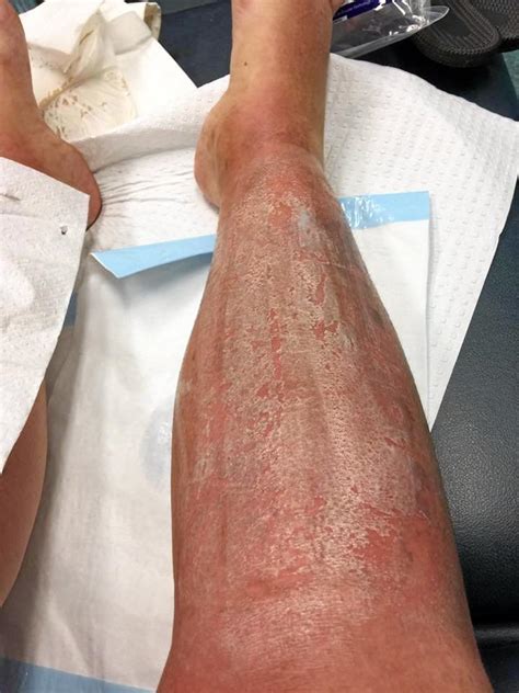 Woman suffers third degree burns from the sun | Fraser Coast Chronicle