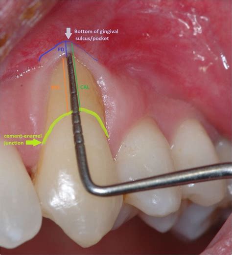 Gingival sulcus | Dental, Dental life, Dentistry