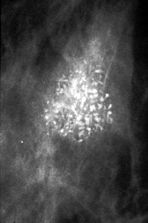 Irregular clustered microcalcifications of ductal carcinoma in situ.