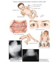 Osteogenesis Imperfecta - Netter Medical Images | Osteogenesis ...