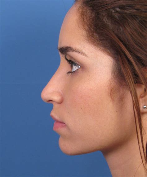 Finesse Ethnic Female Rhinoplasty Surgery | Dr. Hilinski