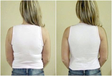 See the amazing "No Back Fat Bra" Before & After Pictures - Shapeez