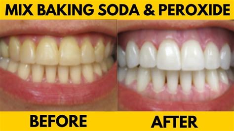Baking soda and Hydrogen Peroxide teeth whitening - #1 DENTIST IN ...