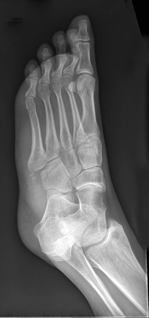 The patterns of injury and management of cuboid fractures | Bone & Joint