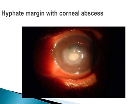 Fungal corneal ulcer