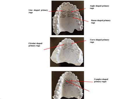 Palatal impressions photographs showing different rugae patterns ...