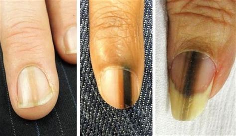 A Day in the Life of a Nail Expert: Melanoma - Health - NAILS Magazine