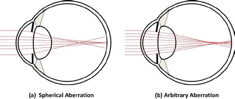 Higher order aberrations of the eye. (a) Spherical aberration with... | Download Scientific Diagram