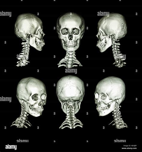 CT scan and 3D image . Normal human skull and cervical spine . all ...