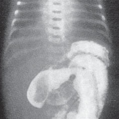 Atresia of the ileum. Note the barium distended small bowel with... | Download Scientific Diagram