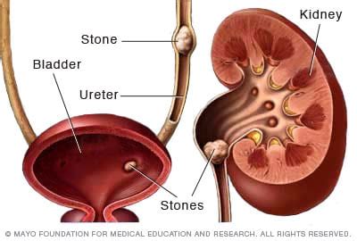 Kidney stones - Symptoms and causes - Mayo Clinic