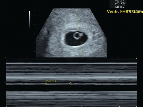 6 Week Ultrasound Heartbeat