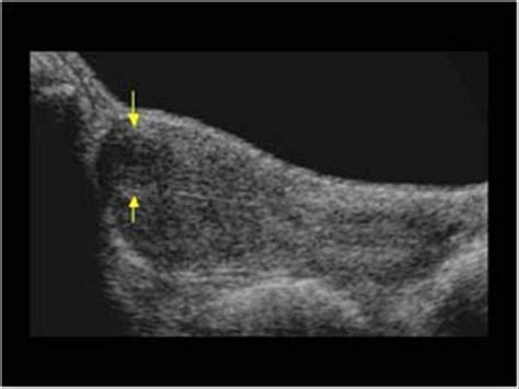 Gynaecology | 3.1 Uterus : Case 3.1.1 Uterine fibroids | Ultrasound Cases