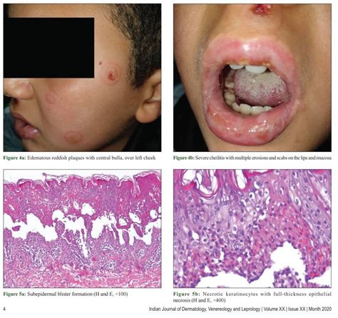 Mycoplasma pneumoniae-induced Rash and Mucositis | HELLO SKIN by หมอผิวหนัง